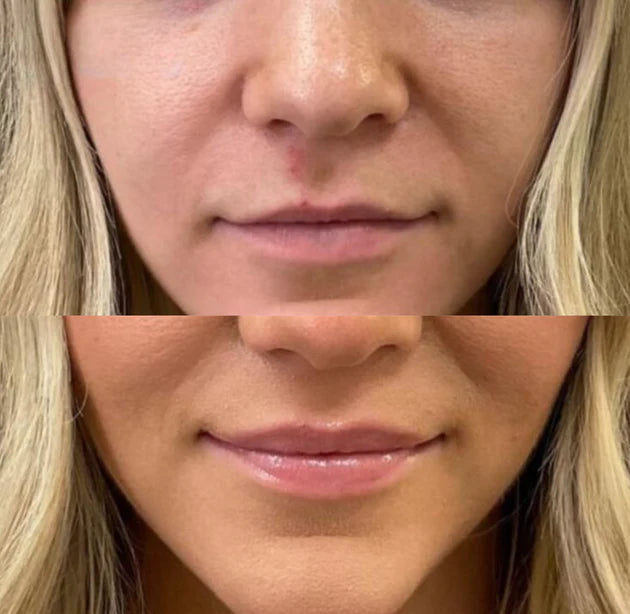 <tc>Lip Plumper</tc>