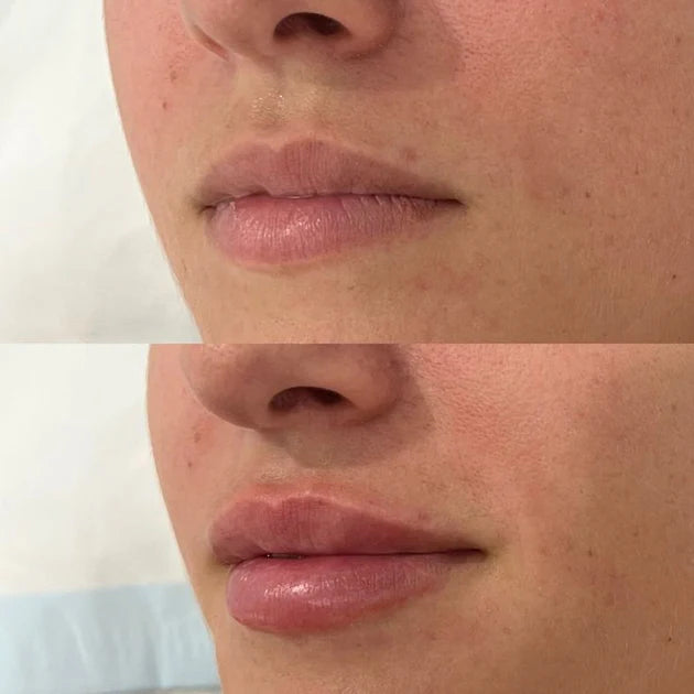 <tc>Lip Plumper</tc>
